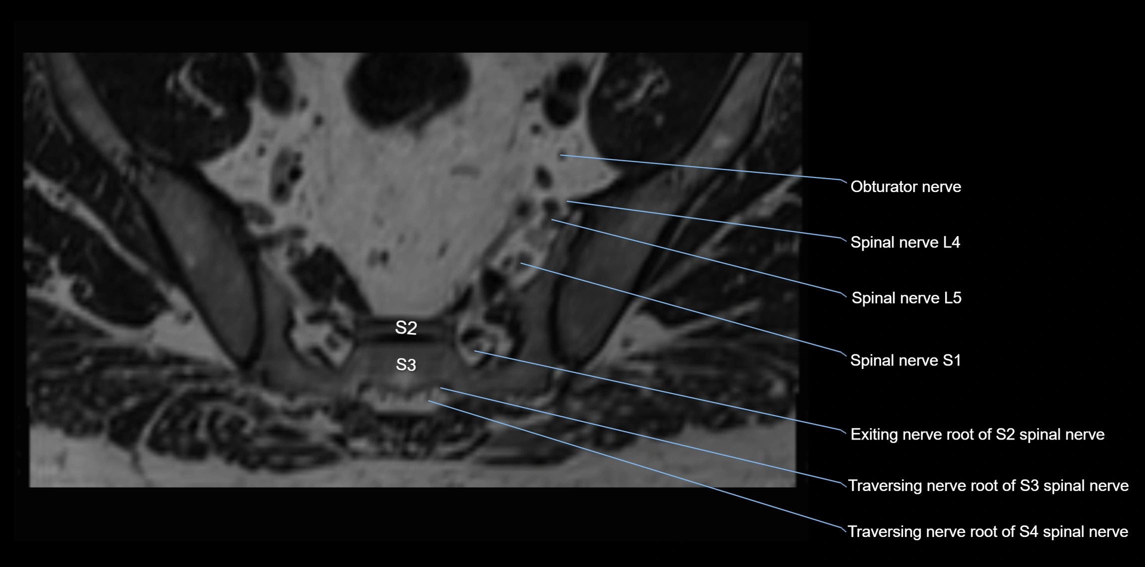 MR lumbosacral plexus axial cross sectional anatomy 3T  radiology  image-img-1008001-00089.webp